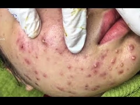 acne and pimples removal cystic acne treatment great removal