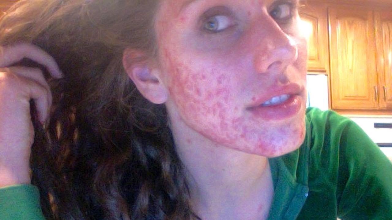 beauty bloggers acne transformation