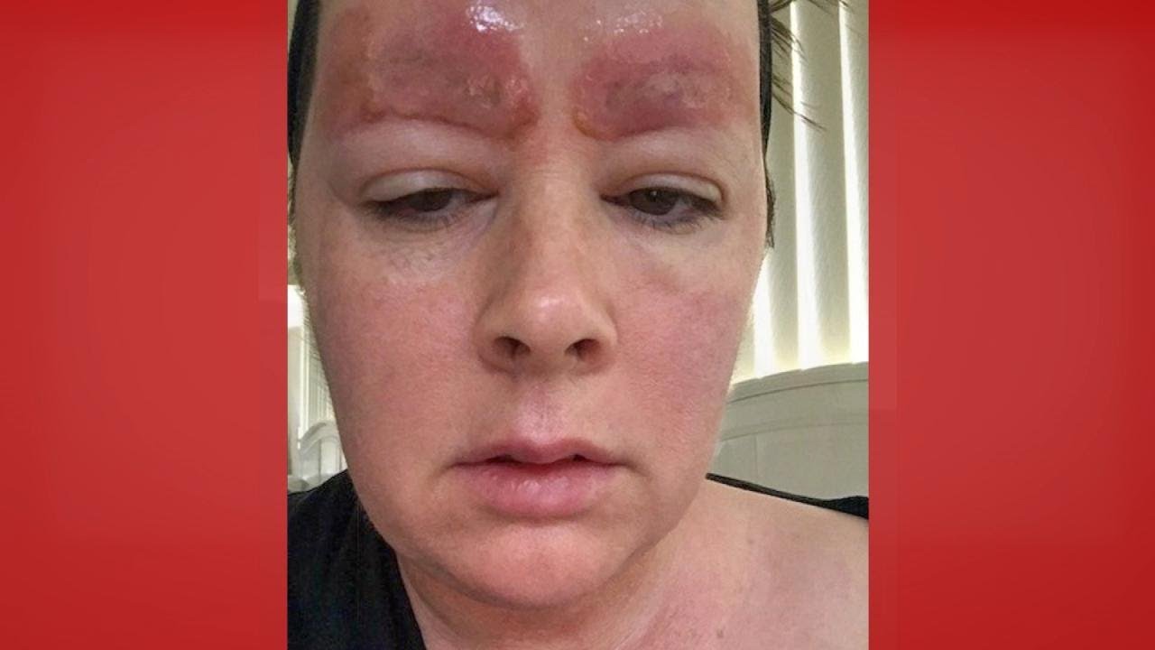 could this happen to you microblading gone wrong the doctors