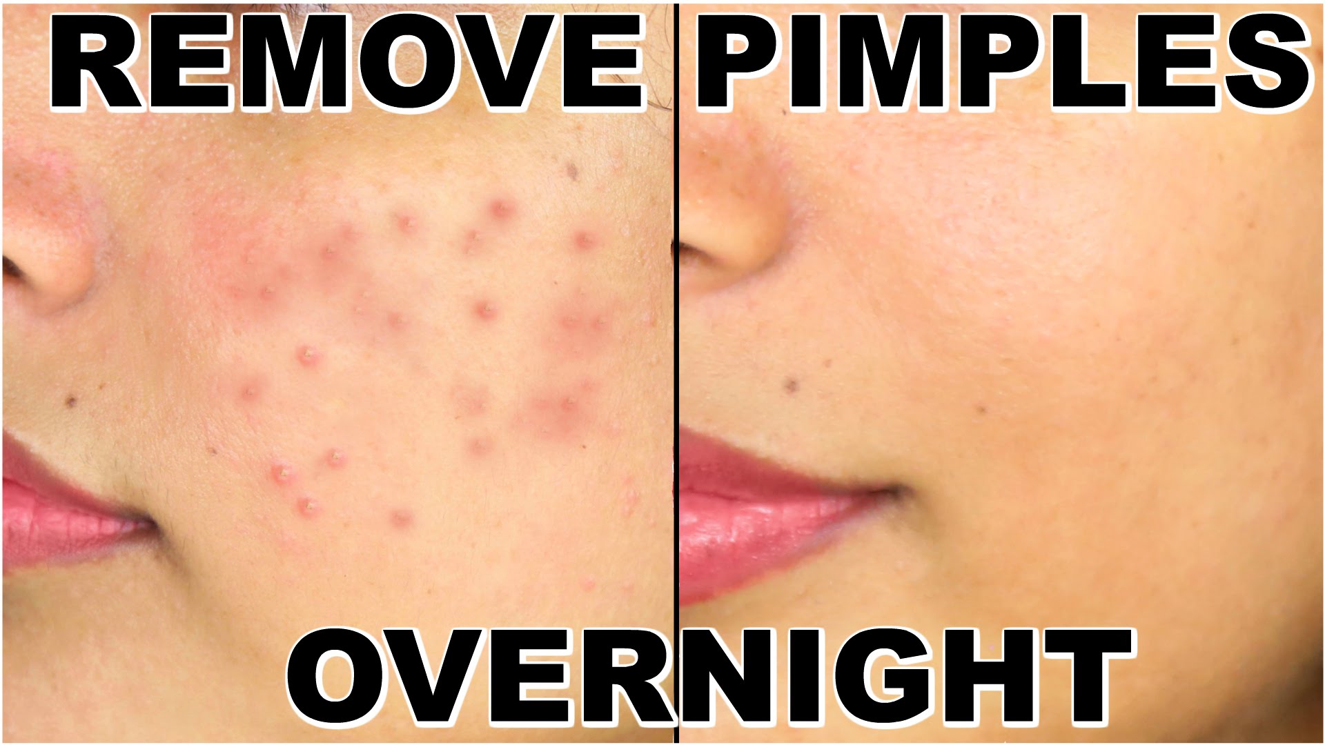 how to remove pimples overnight acne treatment shrutiarjunanand