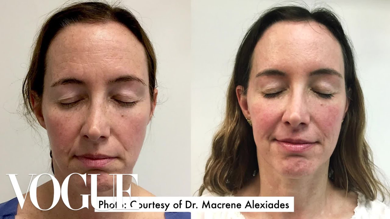 one woman gets 15 cosmetic procedures in 12 months vogue