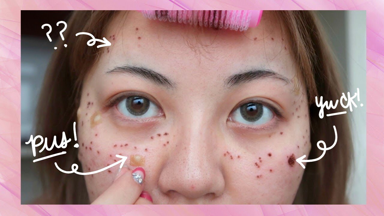results of acne laser treatment before after