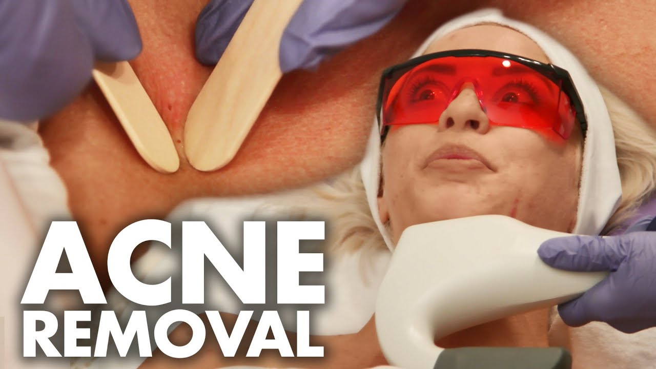 treating acne blackheads w nurse jamie beauty trippin