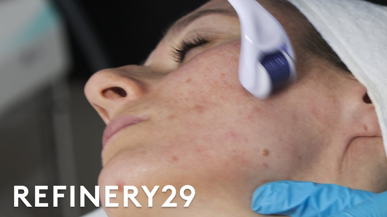 why microneedling is the best acne scar treatment macro beauty refinery29