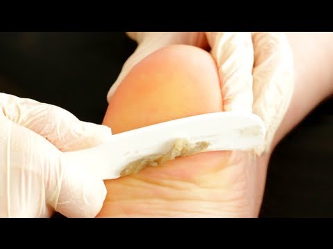 callus peel happy nails promo