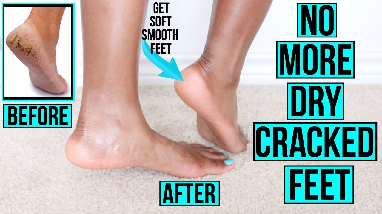 how to get rid of dry cracked feet fast naturally at home remedies more