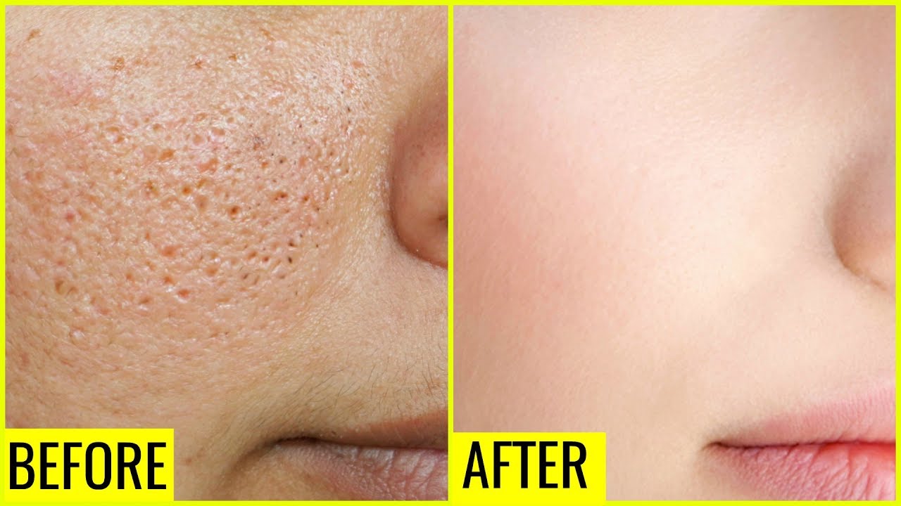 how to get rid of large open pores permanently anaysa